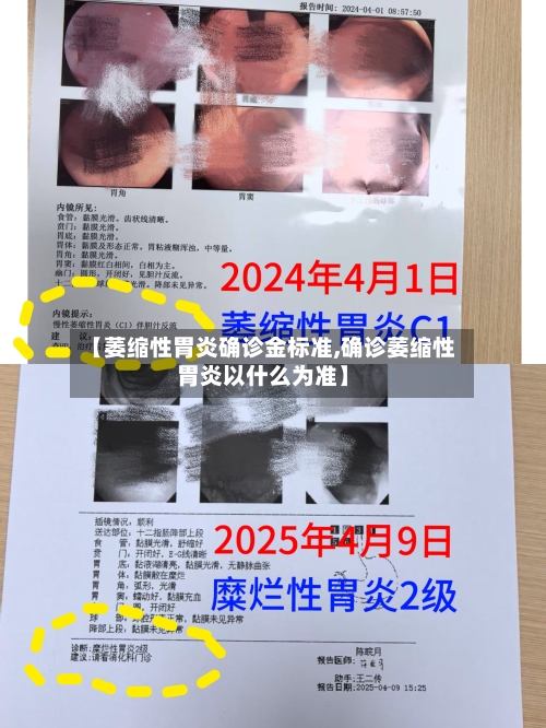 【萎缩性胃炎确诊金标准,确诊萎缩性胃炎以什么为准】
