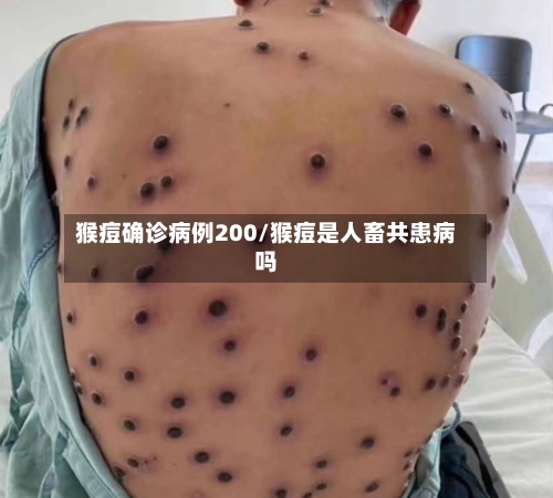 猴痘确诊病例200/猴痘是人畜共患病吗-第3张图片