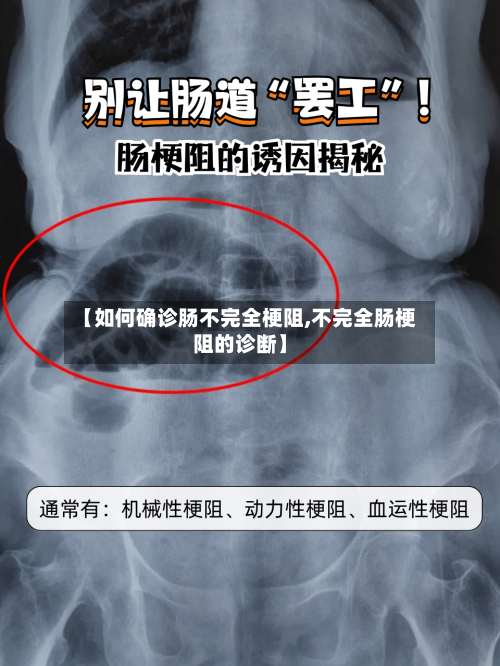 【如何确诊肠不完全梗阻,不完全肠梗阻的诊断】